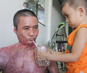 Bị điện giật cháy người không có tiền chạy chữa, bố xót xa nhìn con trai 4 tuổi không nhận ra mình
