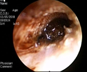 TP.HCM: Bé trai 9 tuổi đang ngủ bị 'vật thể lạ' chui vào tai suýt thủng màng nhĩ