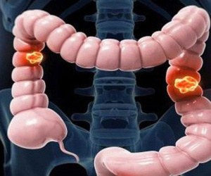 8 người trong một gia đình Tuyên Quang bị ung thư đại tràng
