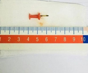 Nuốt phải đinh sắt 1,5cm vào bụng, bé 2 tuổi suýt chết