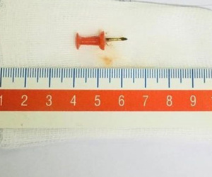 Phát hiện đinh ghim sắt trong phế quản bé gái 12 tuổi