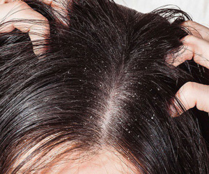 Xử lý khi bị nấm da đầu, tránh khó chịu, ngứa ngáy, mất tự tin vào mùa hè