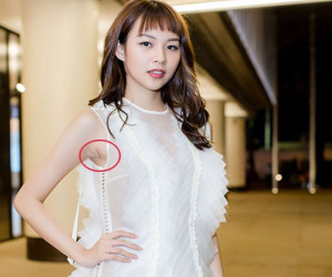 Một mực phủ nhận dao kéo vòng 1 nhưng Phí Phương Anh lại để lộ sẹo khi mặc váy sát nách