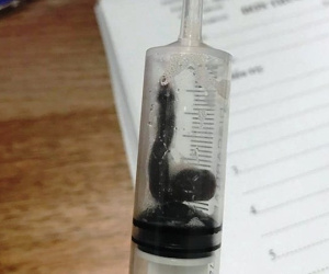 Vắt sống và hút máu trong mũi 2 bệnh nhân gần tháng trời