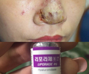 Cô gái 23 tuổi bị hoại tử mũi sau tiêm filler tại một spa
