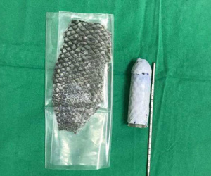 Cô gái không có âm đạo được bác sĩ tái tạo sinh dục bằng da cá
