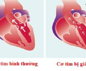 Căn bệnh nào được xem là 'ung thư của tim'?