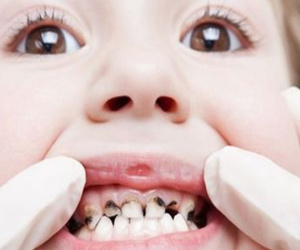 Cách ngăn ngừa và điều trị sâu răng hiệu quả