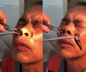 Hãi hùng cảnh lôi đỉa khổng lồ khỏi mũi bệnh nhân