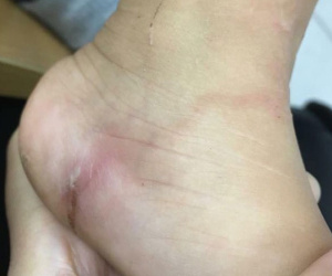Về quê chơi dịp hè, bố kinh hãi phát hiện con gái 5 tuổi bị giun xâm nhập cơ thể, bò lúc nhúc dưới da