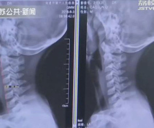 Cảnh báo: Bé 9 tuổi biến dạng xương cổ do xem điện thoại, cha mẹ phát hiện thì đã quá muộn