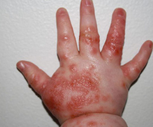Hà Nội: Nguy cơ bùng phát dịch tay chân miệng rất lớn, 6 điều cha mẹ không được bỏ qua