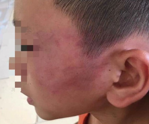 Nghệ An: Nghi án bé trai 12 tuổi bị mẹ kế đánh thương tích đầy mình phải nhập viện