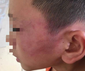 Bé trai 12 tuổi nghi bị mẹ kế đánh nhập viện ở Nghệ An: Mẹ kế là giáo viên, 'do bé ăn nói hỗn láo nên mới dạy'