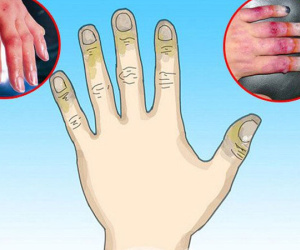 Bỏng lạnh cực nguy hiểm nếu không được sơ cứu đúng cách nhưng mọi người vẫn chưa nâng cao cảnh giác