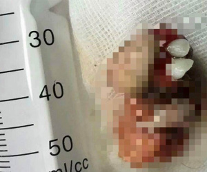 Khối u mọc răng, tóc trong buồng trứng bé gái