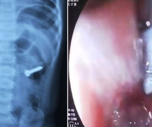Bé 2 tuổi suýt mất mạng vì nuốt phải đinh ốc xoắn dài 3cm vào bụng