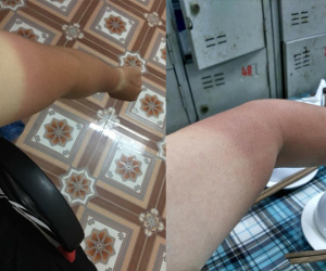 Dùng bìa carton chống nóng vẫn không ăn thua, dân mạng bất lực chia sẻ ảnh làn da 'hai màu' vì cháy nắng