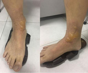 Từ trường hợp bị bỏng khi đi mát xa chân, bác sĩ hướng dẫn cách sơ cứu an toàn nhất