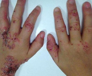 Bé gái 3 tuổi bị mụn rộp, lở loét đến phát sợ - thêm một nạn nhân của 'nụ hôn thần chết'
