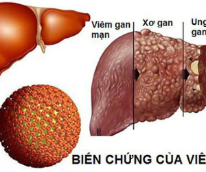 Căn bệnh nguy hiểm có thể dẫn đến ung thư gan: Tốn 400 triệu vẫn không chữa được