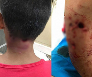 Thêm một bé trai bị chó cắn thủng tay và gáy khi cho chó ăn
