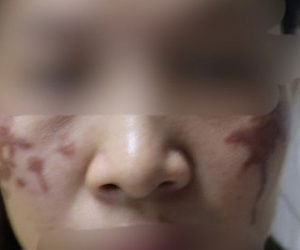 Mặt loang lổ sạm đen vì chấm axit chữa nám da