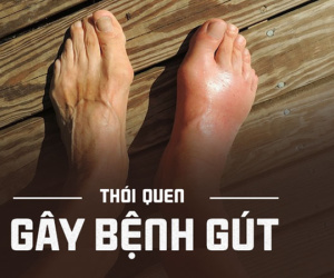 Nhiều người vô tình làm những việc này, đến khi đau không đi nổi mới biết bị mắc bệnh gút