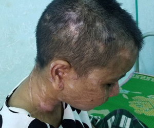 Vụ cô gái bị tra tấn dã man như thời trung cổ: Y Nhiêu được bác sĩ Chiêm Quốc Thái tài trợ phẫu thuật miễn phí