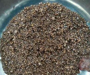 Bác sĩ sốc khi lấy ra gần 3.000 viên sỏi trong thận bệnh nhân