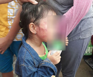 TP.HCM: Bé gái 5 tuổi nghi bị bảo mẫu tát liên tục đến sưng mặt, dọa lấy kéo cắt lưỡi nếu nói cho gia đình biết
