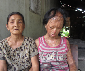 Bà nội bé gái bị tạt axit năm 7 tuổi vì mẹ 'giật chồng' người khác rồi bỏ rơi đã đến TP.HCM để xin đôi mắt tử tù cứu cháu