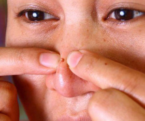 Đứa trẻ 10 tuổi phải phẫu thuật não, chỉ vì mẹ nặn mụn đầu đen ở mũi