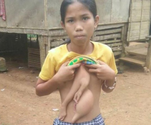Bé gái 14 năm sống chung với 2 cánh tay thừa lủng lẳng trên ngực và bụng
