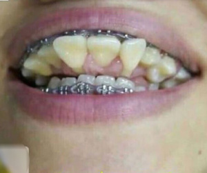 Xôn xao hàm răng chổng ngược khiến ai cũng hoảng hốt, biết lý do lại càng đau lòng