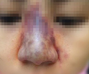 Làm đẹp bằng tiêm chất làm đầy (filler): Tai biến nguy hiểm, khó hồi phục