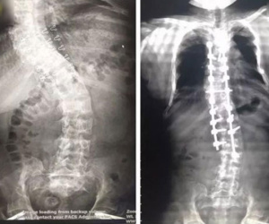 Sáng dậy cô gái 17 tuổi bỗng thấy lùn đi 5cm, nhìn phim chụp liền hiểu lý do