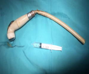 Vòi xịt vệ sinh kẹt trong hậu môn thanh niên 18 tuổi