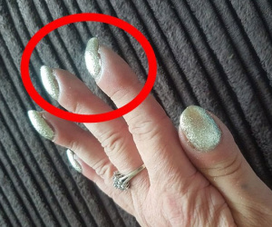 Nếu móng tay quặp vào kỳ lạ như người phụ nữ này, bạn nên nhanh chóng đi khám bác sĩ vì đó là dấu hiệu căn bệnh 'tử thần'