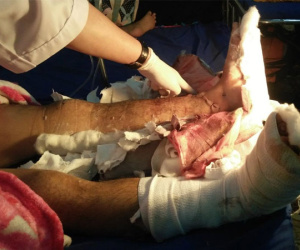 Nam thanh niên bị kẻ lạ chém đứt lìa 2 bàn chân