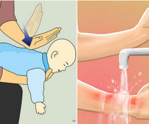 Sai lầm khi sơ cứu đa số người mắc phải