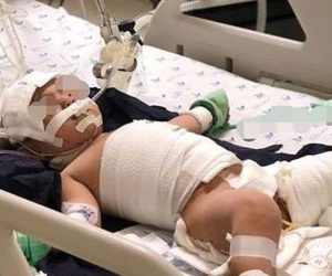 Mắc dây ấm đun siêu tốc, bé 20 tháng tuổi bỏng nặng