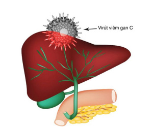 Viêm gan siêu vi C và các biến chứng thường gặp