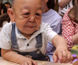 Bệnh lạ khiến bé 6 tuổi trông như ông cụ
