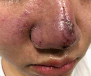 Hà Nội: Một phụ nữ méo mặt, mũi bọc mủ vì tiêm filler làm đẹp
