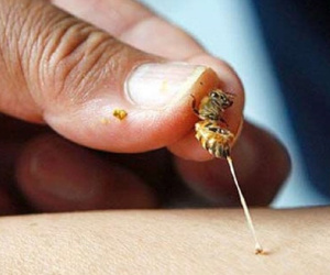Chọc phá tổ ong, bé trai 5 tuổi suy đa phủ tạng nguy kịch