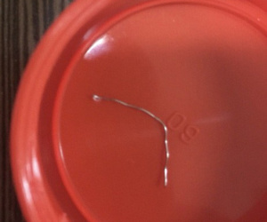 Chuyện hy hữu: Nuốt thanh kẽm dài 7 cm mà không hay biết
