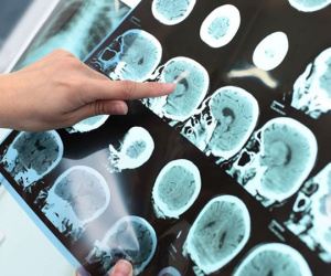 Đột quỵ não: Không còn chỉ người già, càng ngày thanh niên ngoài 20 càng hay mắc phải