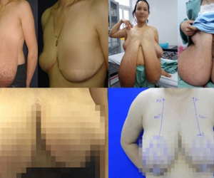 Ngực quá khổ 1,1m như hotgirl Hải Dương, người phụ nữ nhiều lần ngã sấp mặt