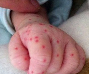 Triệu chứng bé bị sốt xuất huyết
